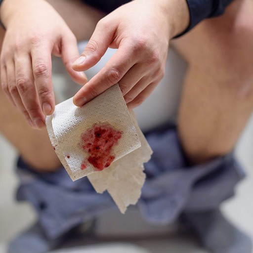 Rectal bleeding and blood in stools