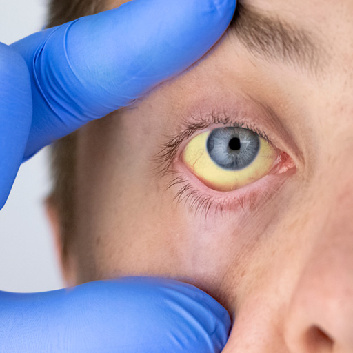Yellowing of the eyes (jaundice)